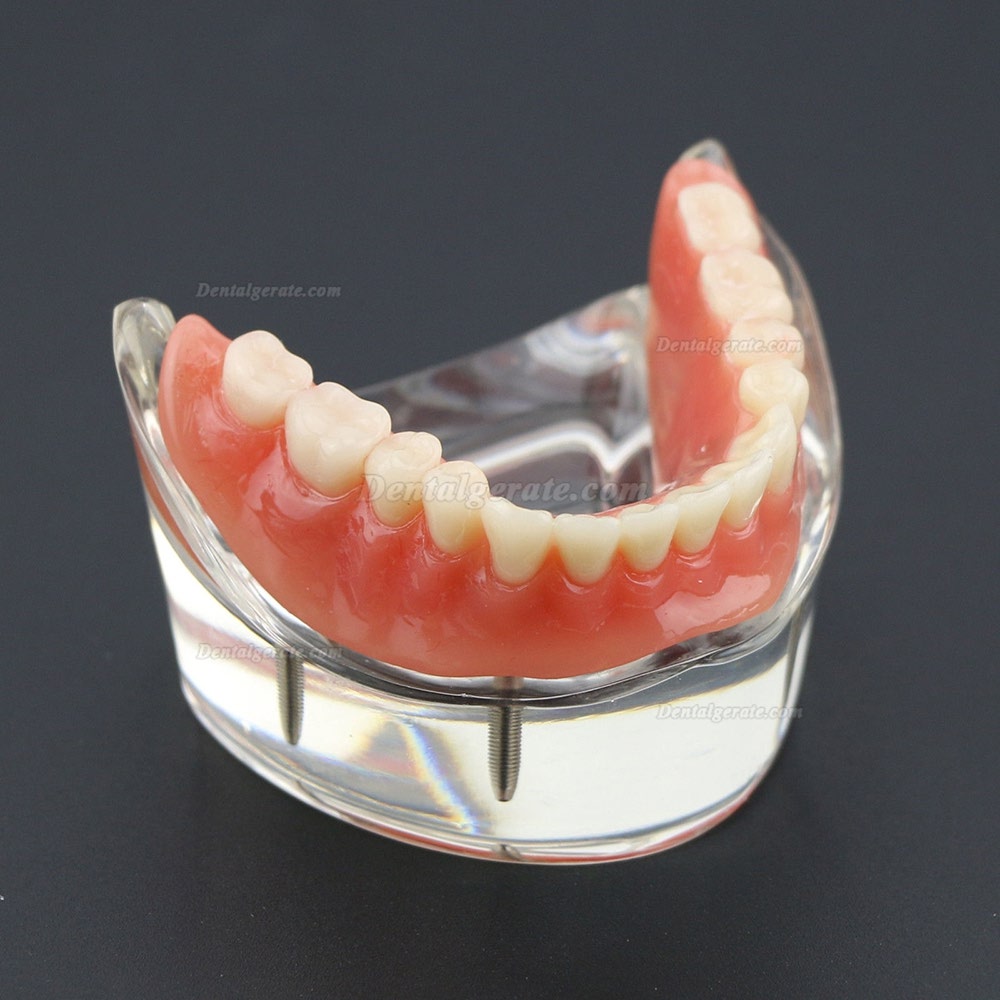 Dental Lower Z&auml;hne Demo-Studienmodell 6002 02 Overdenture Unten 4 Implantate
